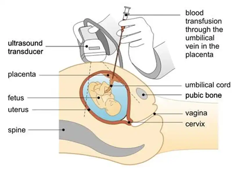 Intrauterine Transfusion